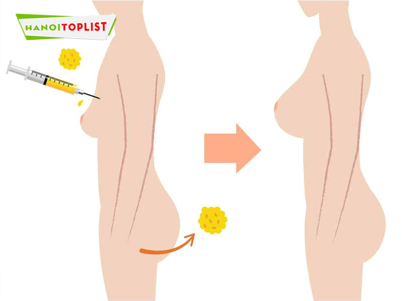 cac-phuong-phap-nang-vong-1-pho-bien-hien-nay-hanoitoplist